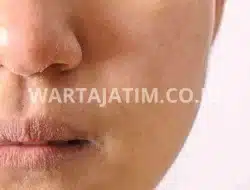 Kulit Kering, Pertanda Anemia Yang Perlu Diwaspadai!